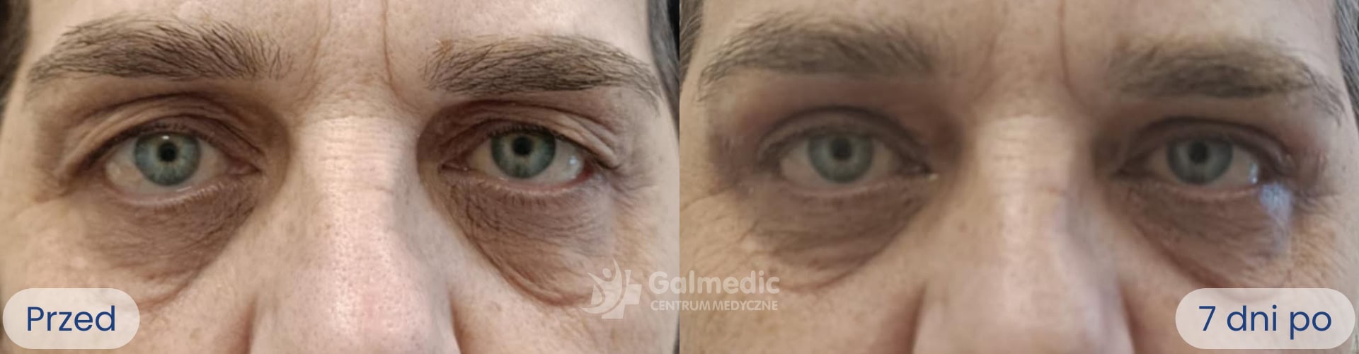 plastyka powiek górnych