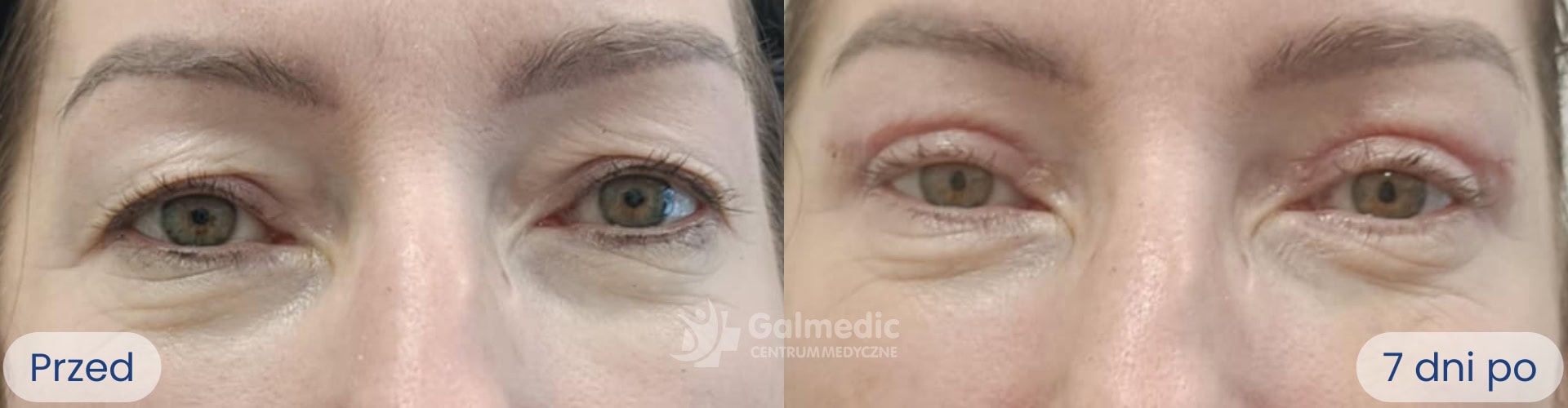 plastyka powiek górnych