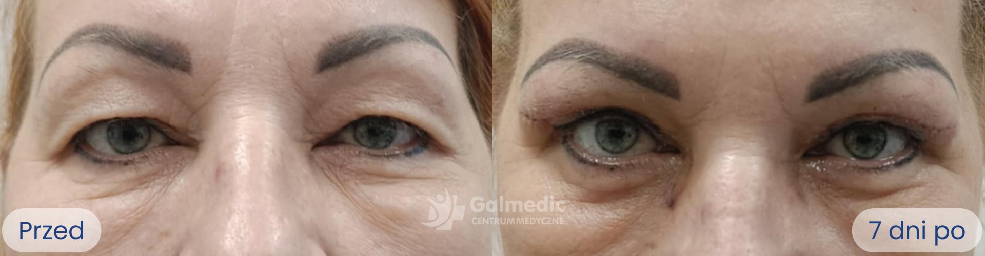 plastyka powiek górnych