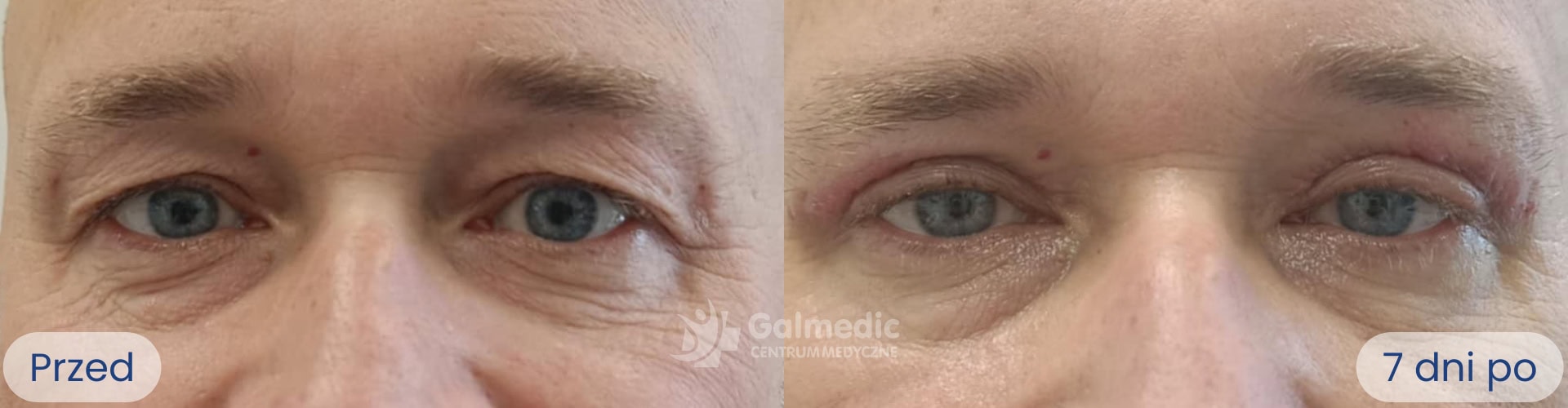 plastyka powiek górnych