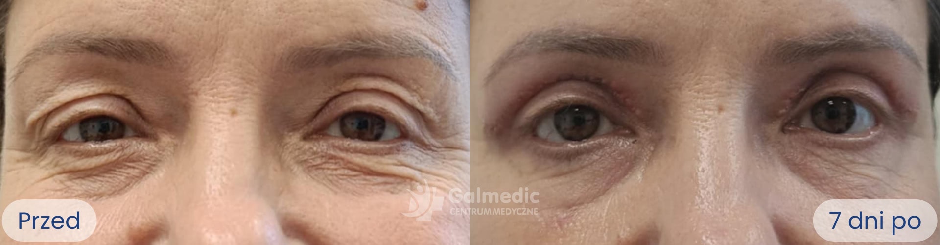 plastyka powiek górnych