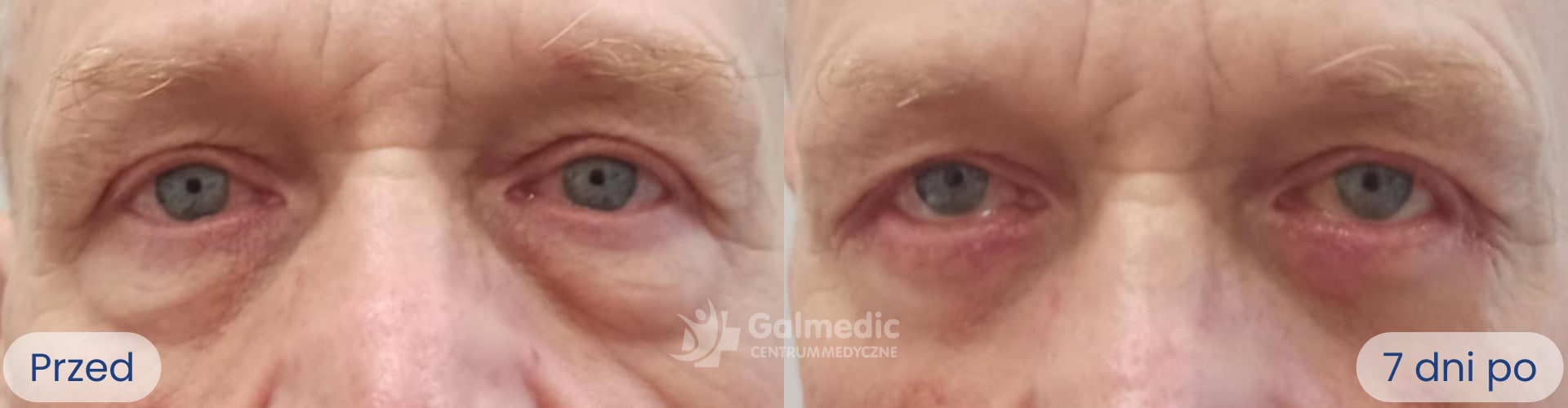 plastyka powiek górnych