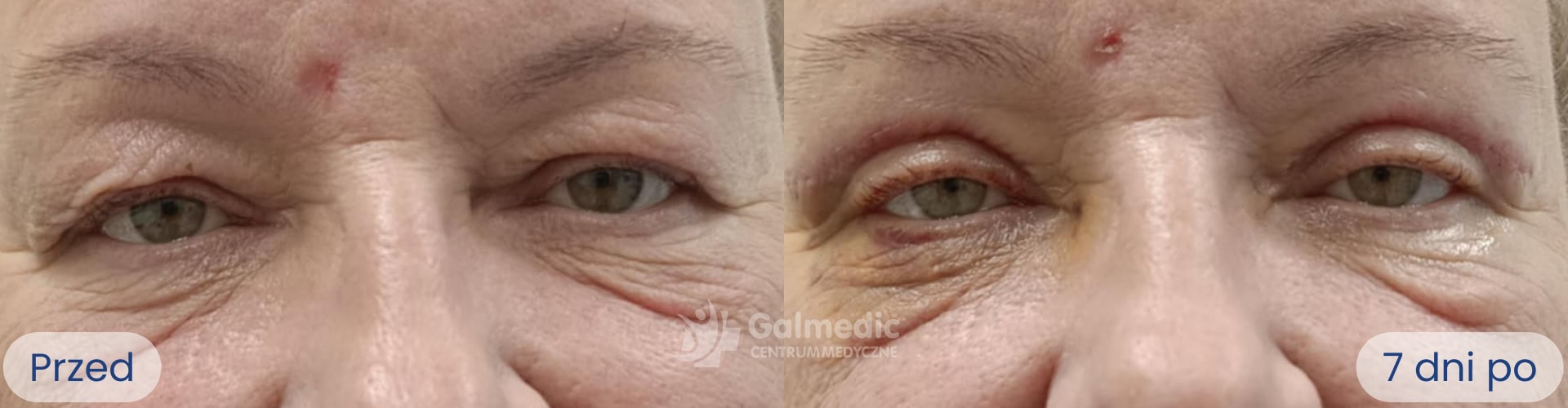 plastyka powiek górnych