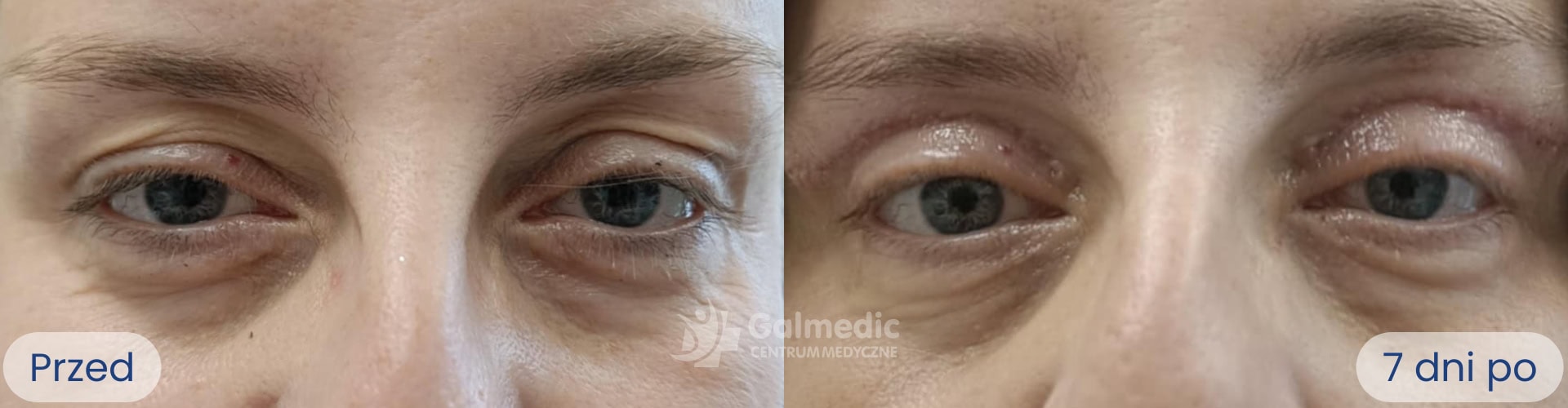 plastyka powiek górnych